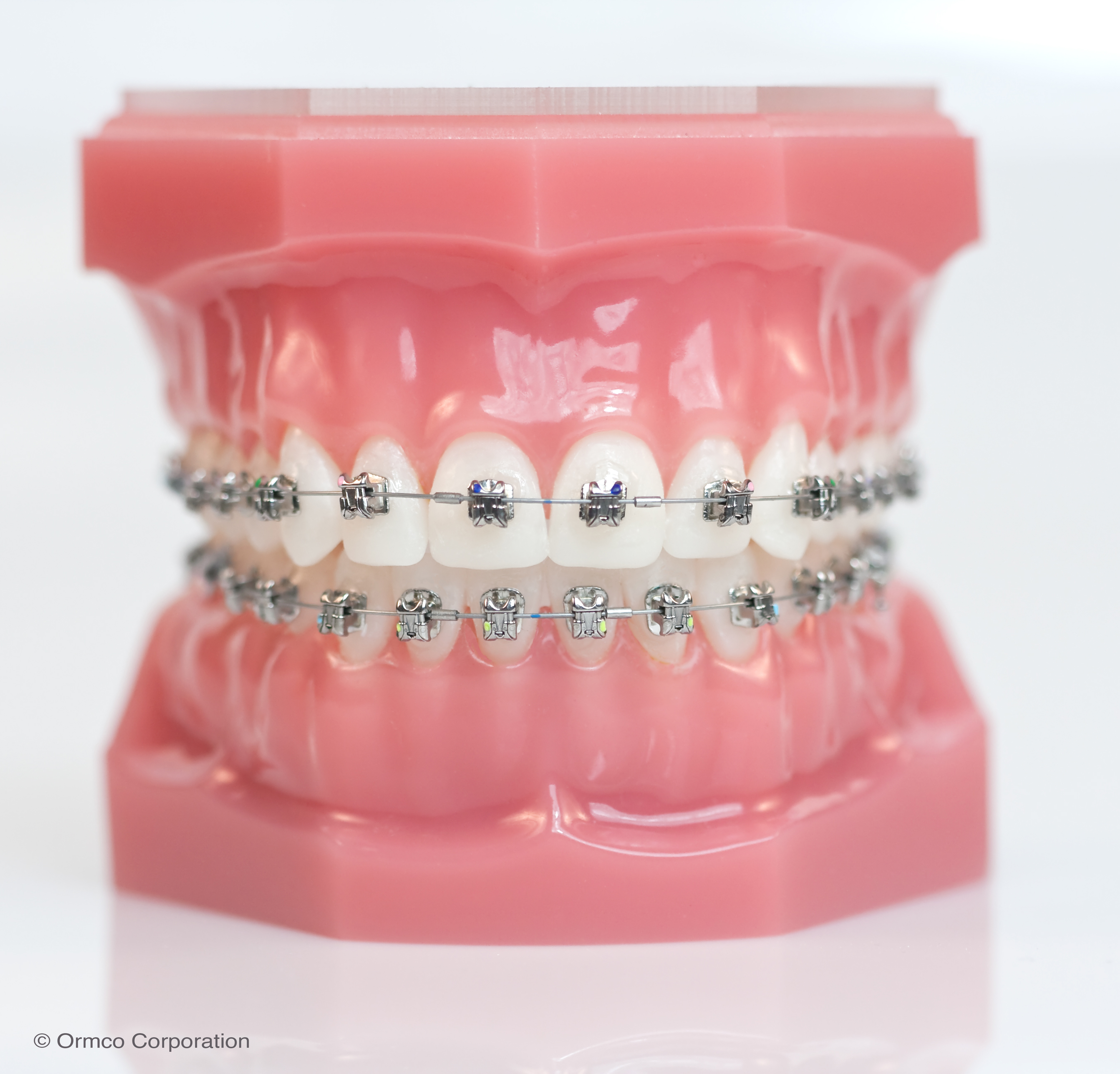 Damon System Fixed Braces